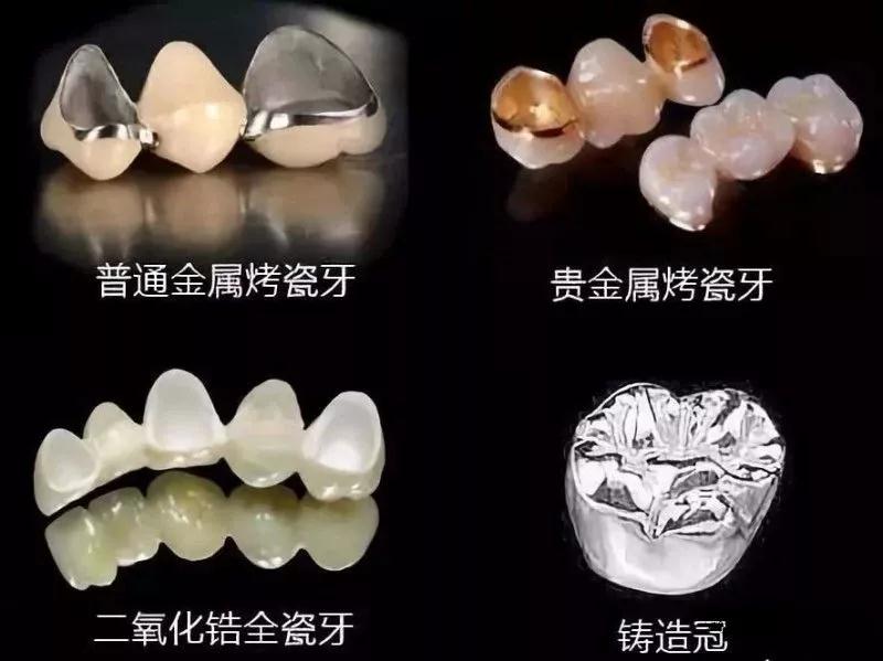 种植牙:重塑生命的微笑